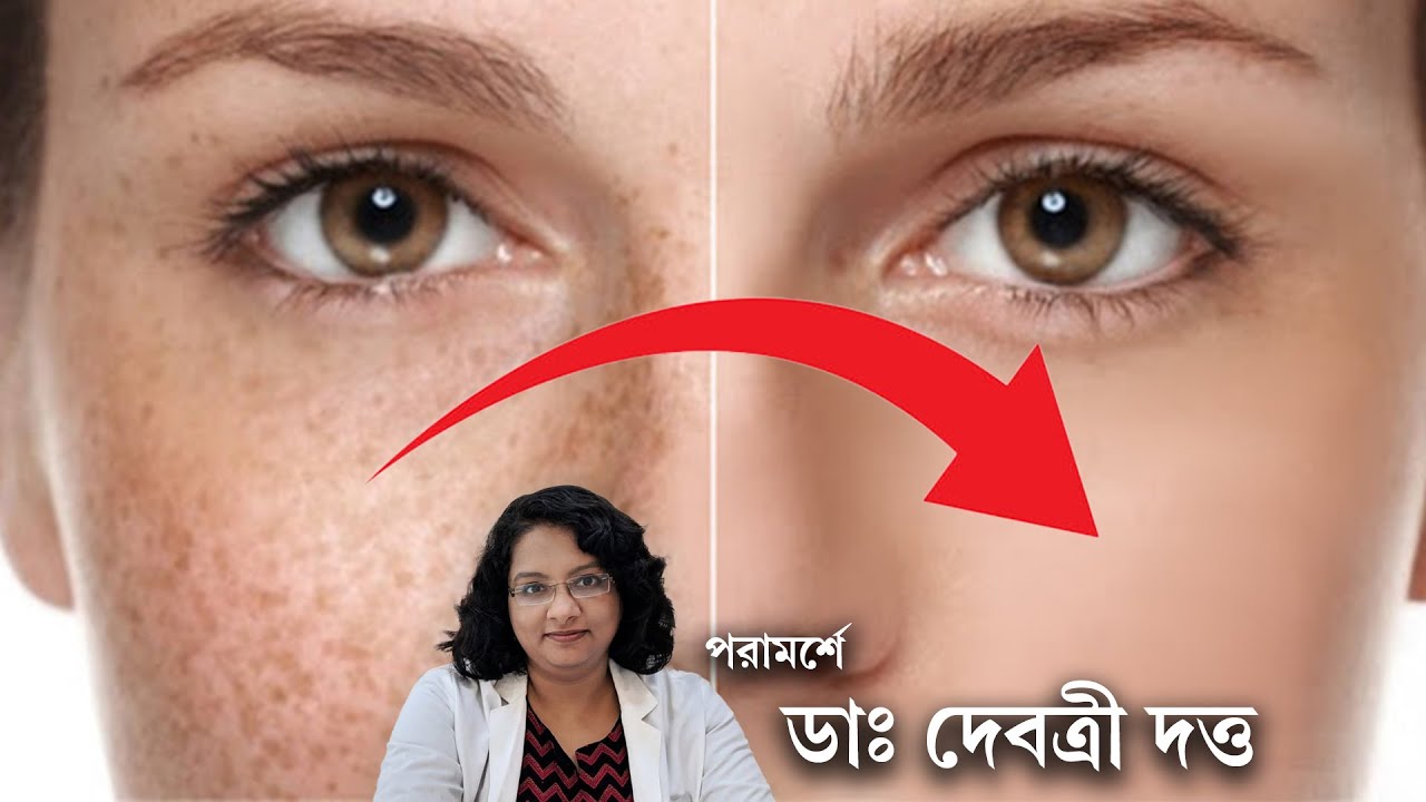 ফ্রেকলস: তিল, ট্যান না আরো কিছু? জেনে নিন কারণ ও চিকিৎসা | Freckles: what they are and how to treat