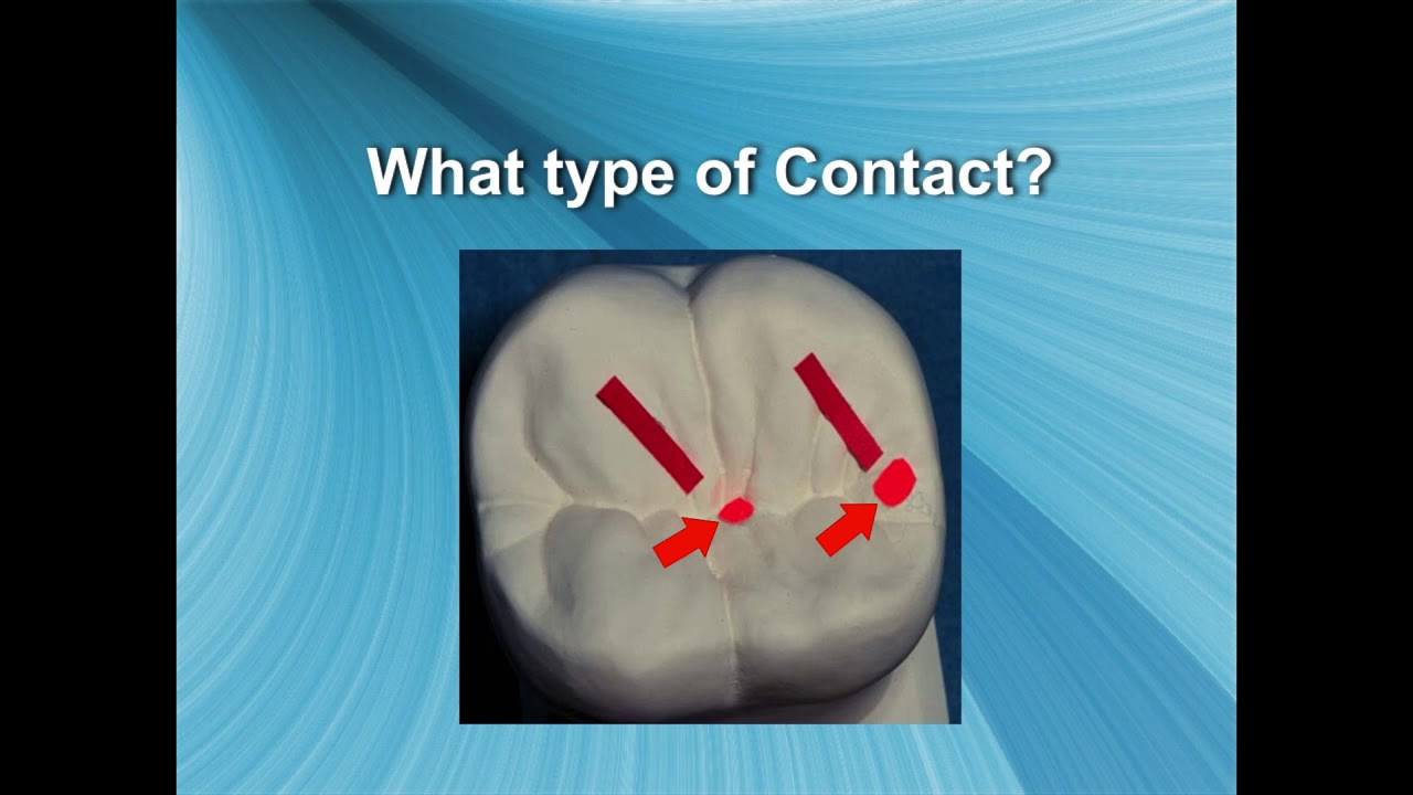Setting Posterior Denture Teeth (Narrated Presentation)