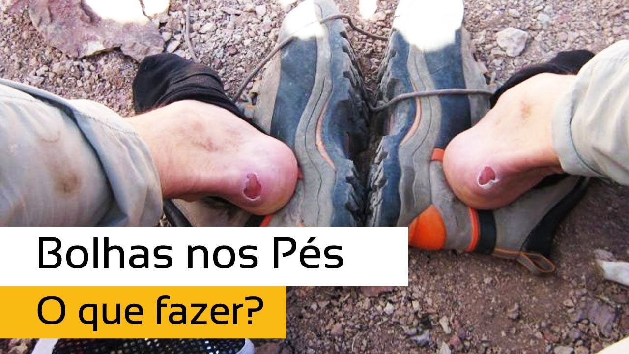 Bolhas nos Pés: O que fazer?