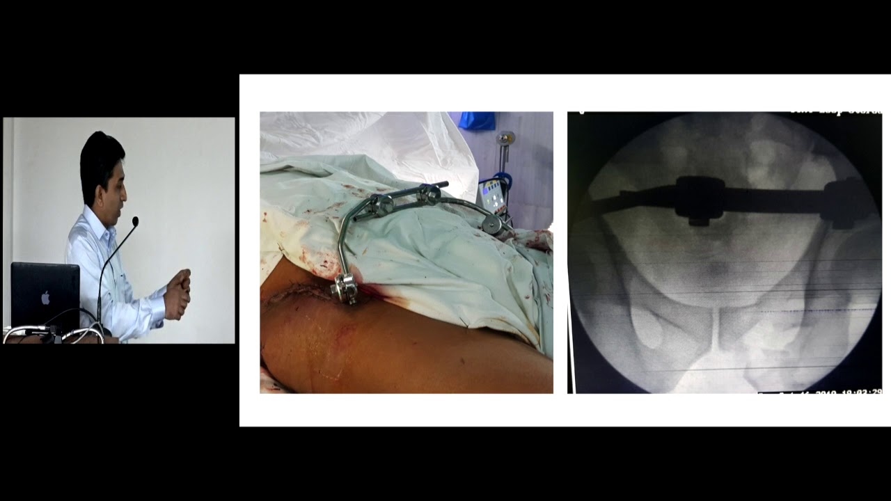 Pelvic External Fixators - Dr Pradip Nemade