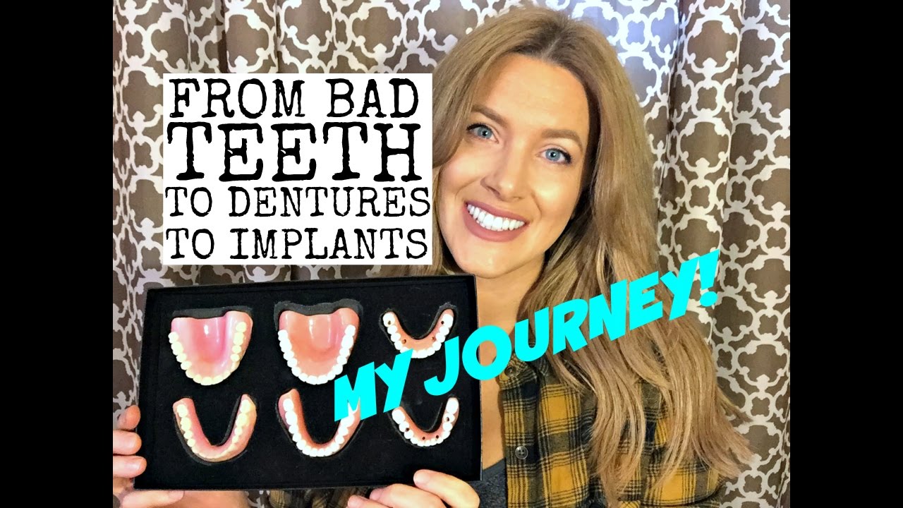 Bad teeth, dentures, and dental implants: My Story
