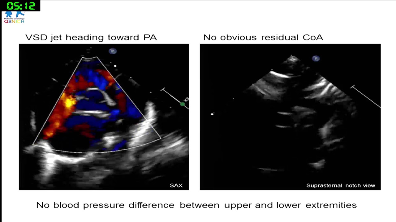 Helping the baby out: device closure for outlet VSD with respiratory failure