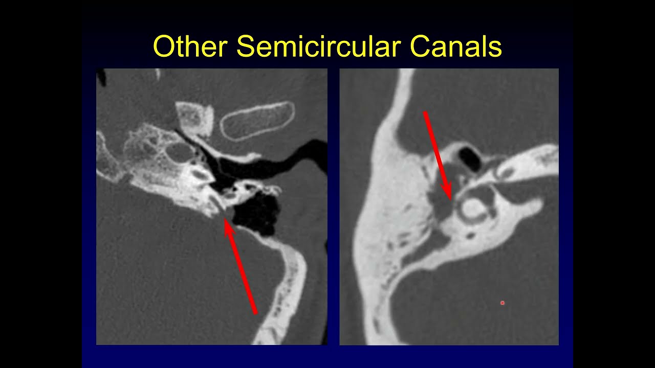 Third Window Phenomena