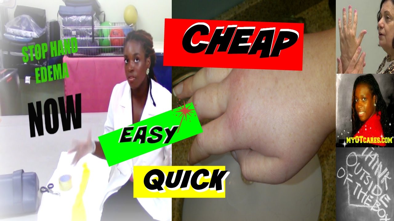HOW TO GET RID OF EDEMA (SWELLING): occupational therapist perspective