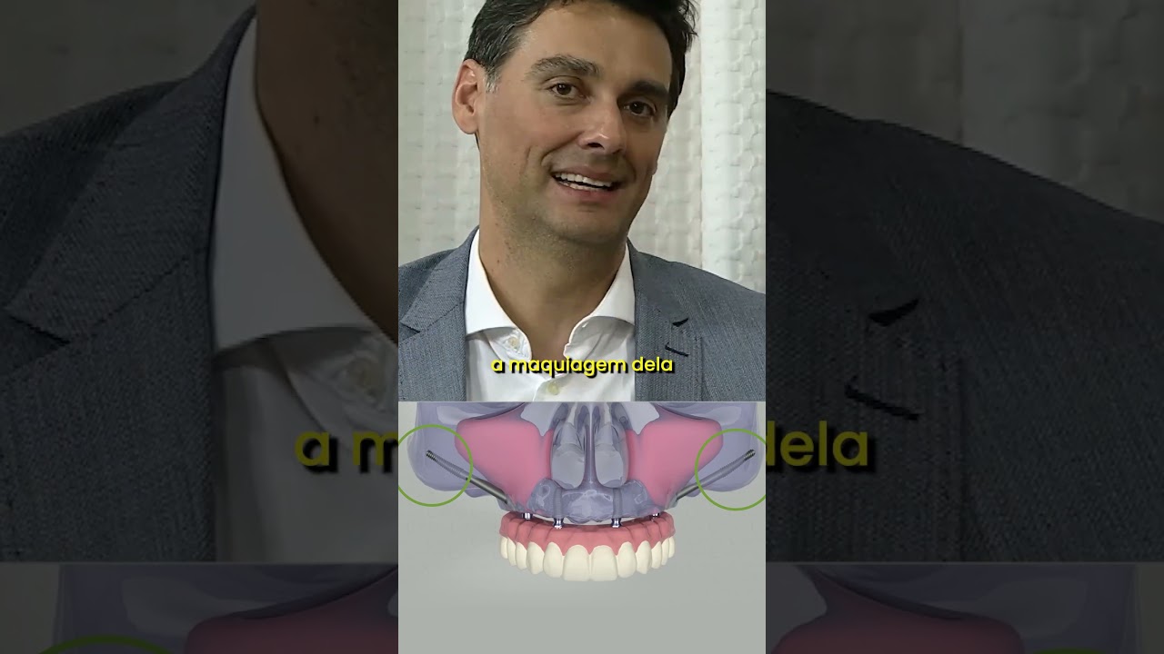 Entenda Como Funciona o Implante Zigom&aacute;tico - Implace Implantes