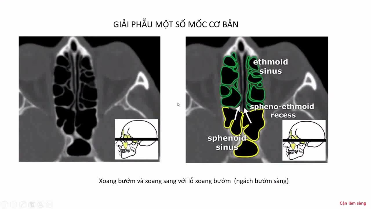 CĐHA XOANG HÀM MẶT | TS. LÊ VĂN KHẢNG