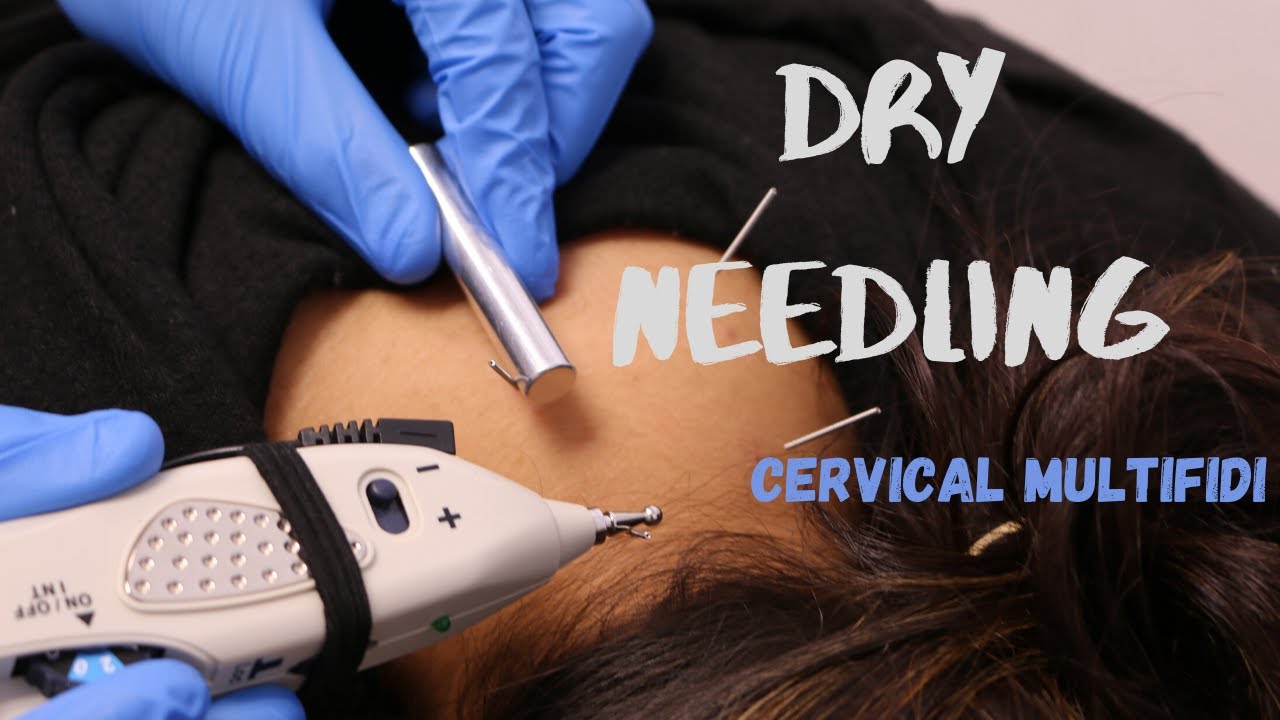 Dry Needling the CERVICAL spine for HEADACHES and NECK pain!!