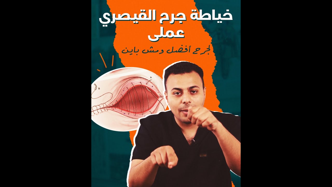 جرح القيصرية مش باين ازاي؟ - خطوات القيصرية وافضل خياطة للجرح