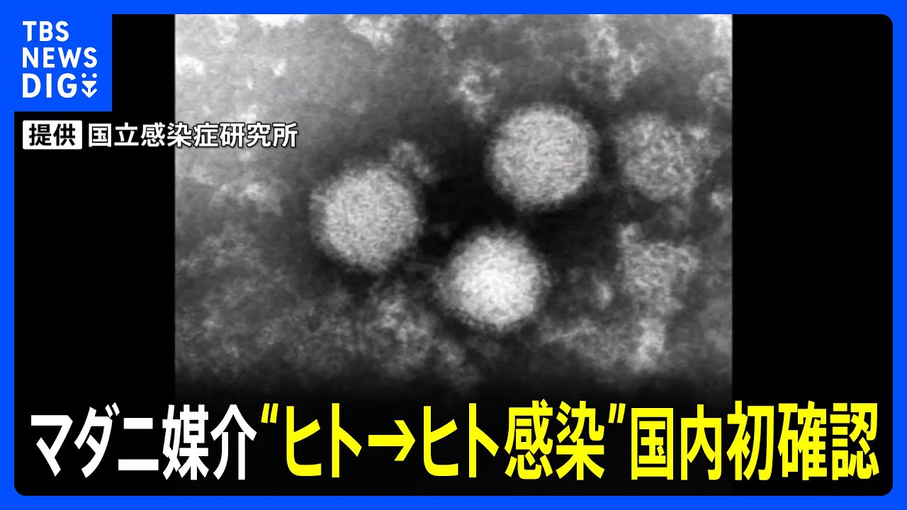 患者→医師への“ヒト→ヒト感染”国内初確認　マダニ感染症「SFTS」国立感染症研究所は注意呼びかけ｜TBS NEWS DIG