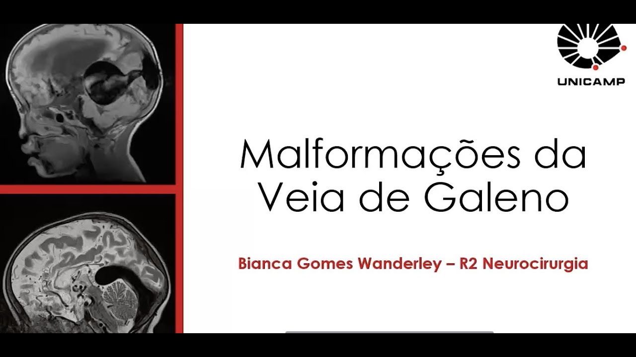 Aula Malformações Veia de Galeno