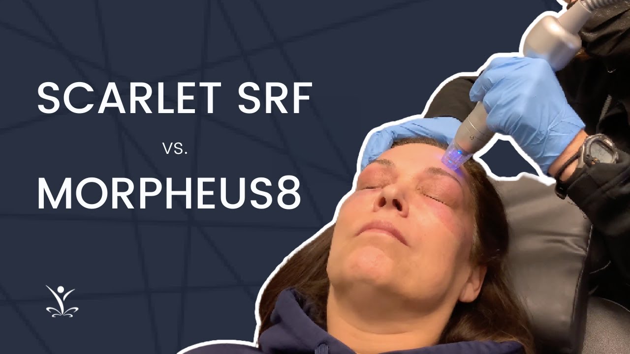 Why Scarlet SRF Instead of Morpheus8 or Pixel?