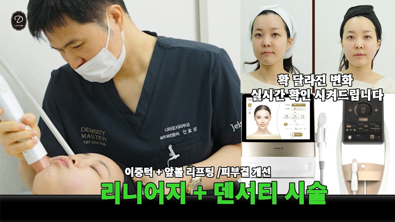 덴서티리프팅 300샷 더하기 리니어지 300샷 실제 시술 후기~♥ #디라운지피부과 #신사동피부장인 #덴서티 #리니어지