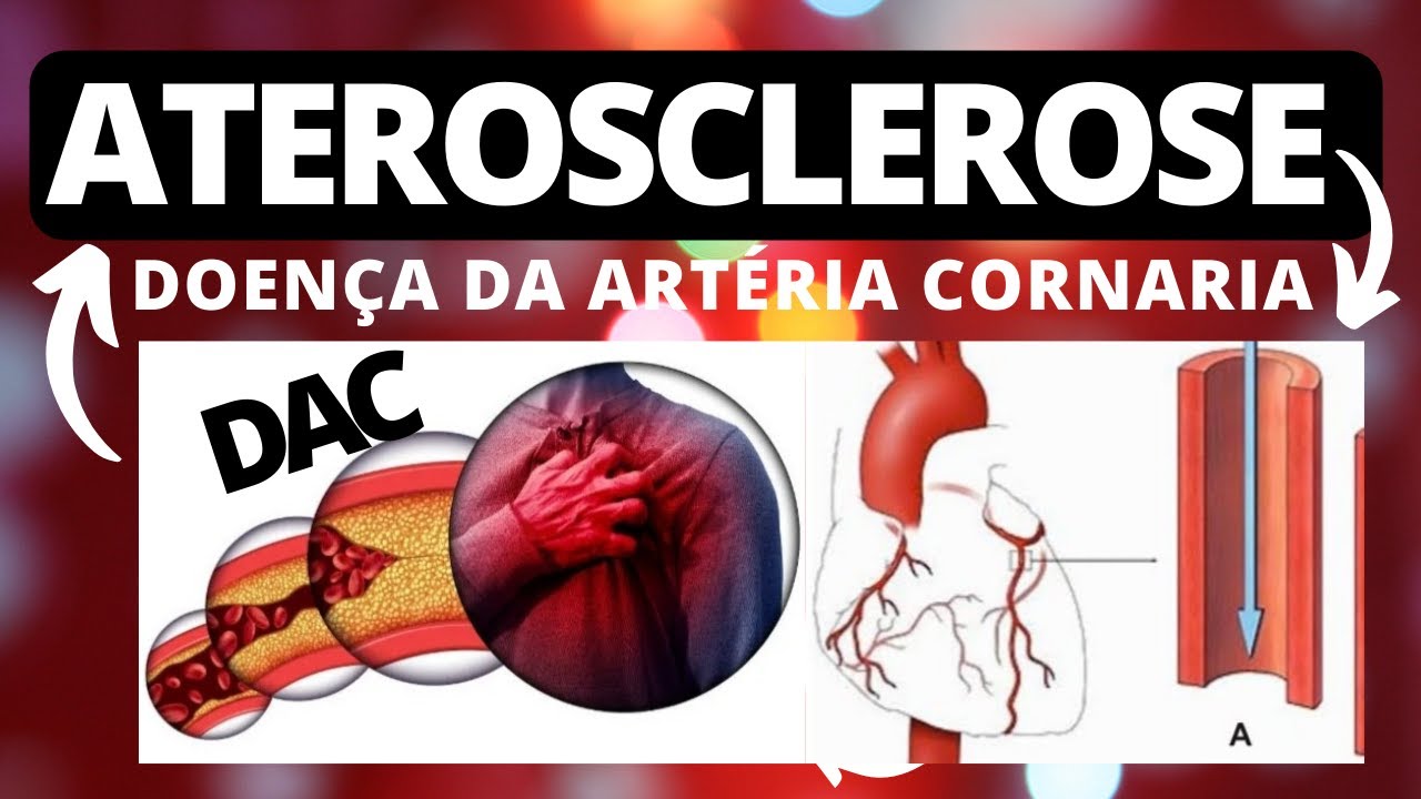 ATEROSCLEROSE CORONARIANA: Definição, fisiopatologia, manifestações clínicas, fatores de riscos.