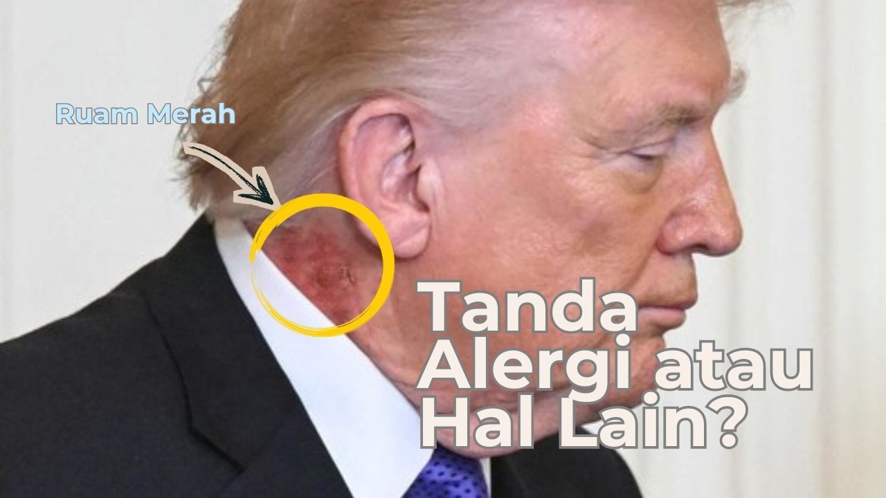Ada Bercak Merah di Leher Donald Trump, Apa Penyebabnya? #donaldtrump #bercakmerah #kesehatankulit