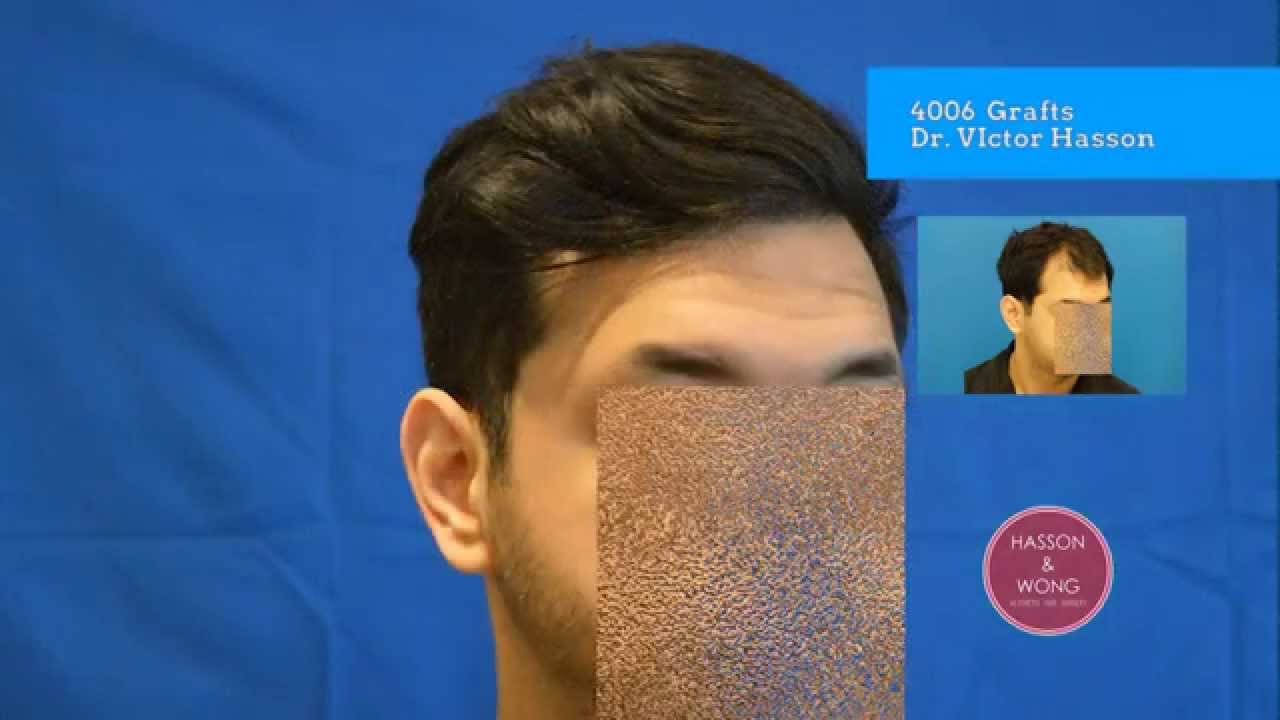 Incredible Hair Transplant Before and After Results Dr Hasson 4006 Grafts