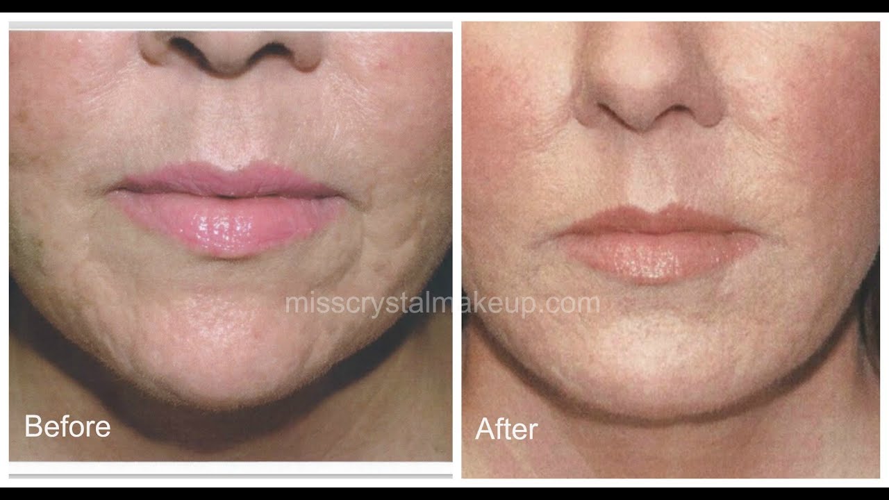 Juvederm Filler For Acne Scars