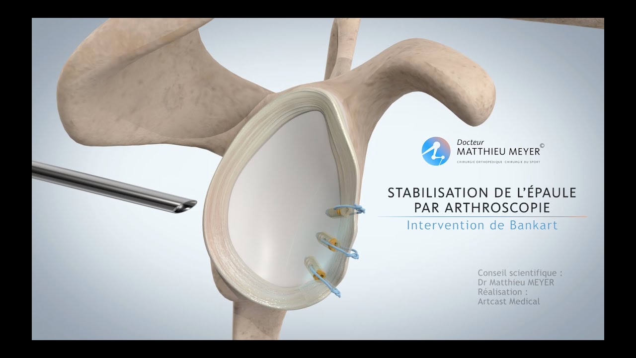 STABILISATION DE L'ÉPAULE PAR ARTHROSCOPIE (INTERVENTION DE BANKART) - DR MATTHIEU MEYER