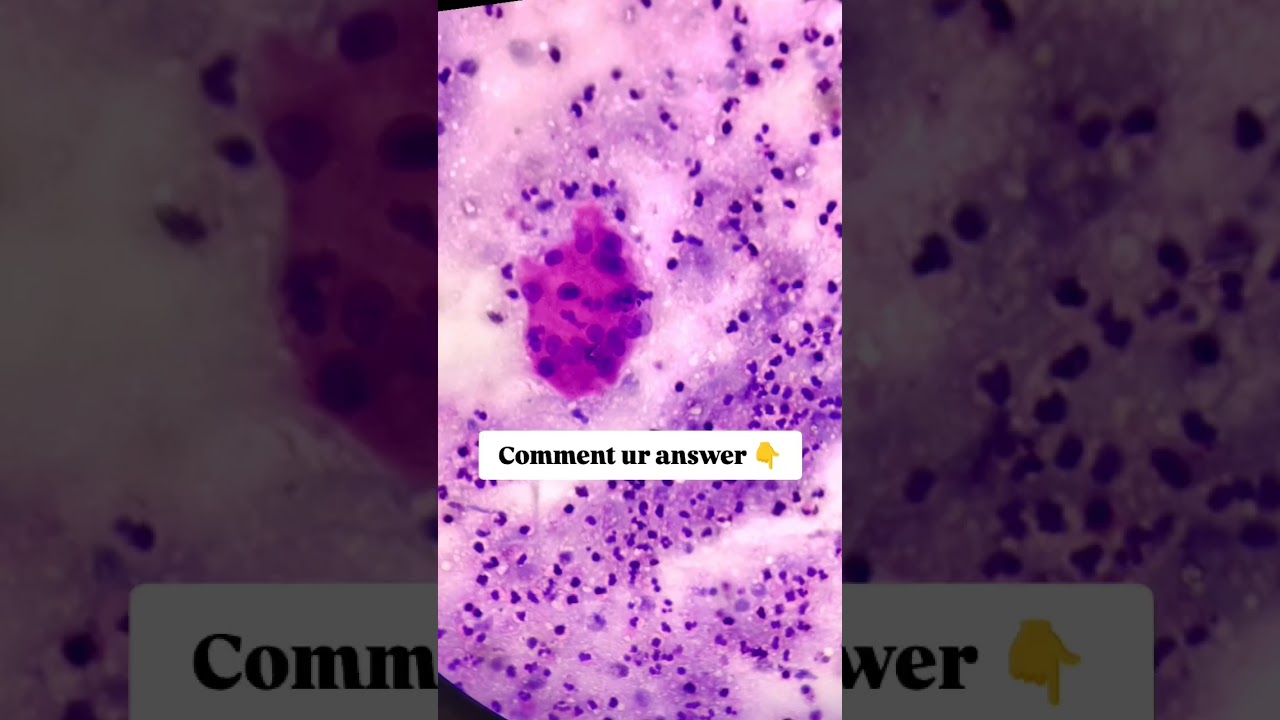 Identify the fnac findings, post auricular abscess 28/F, history of weight loss.Comment below 👇👇