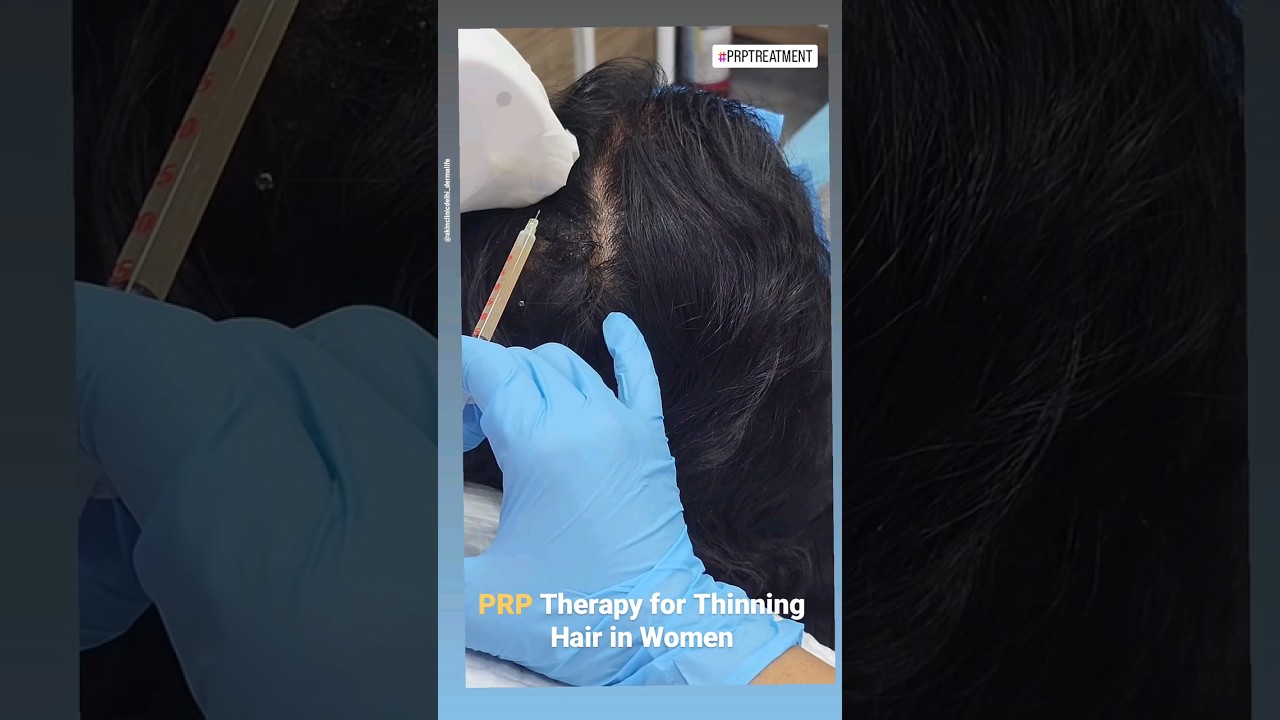 PRP Therapy For Thinning Hair in Women | Does PRP Work for Hair Loss in Females?