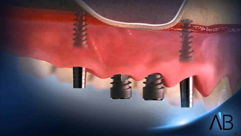 Short maxilla implants