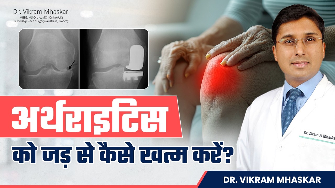 घुटनो का घिसना | Osteoarthritis से छुटकारा कैसे पाएं? | Osteoarthritis के Best Treatment