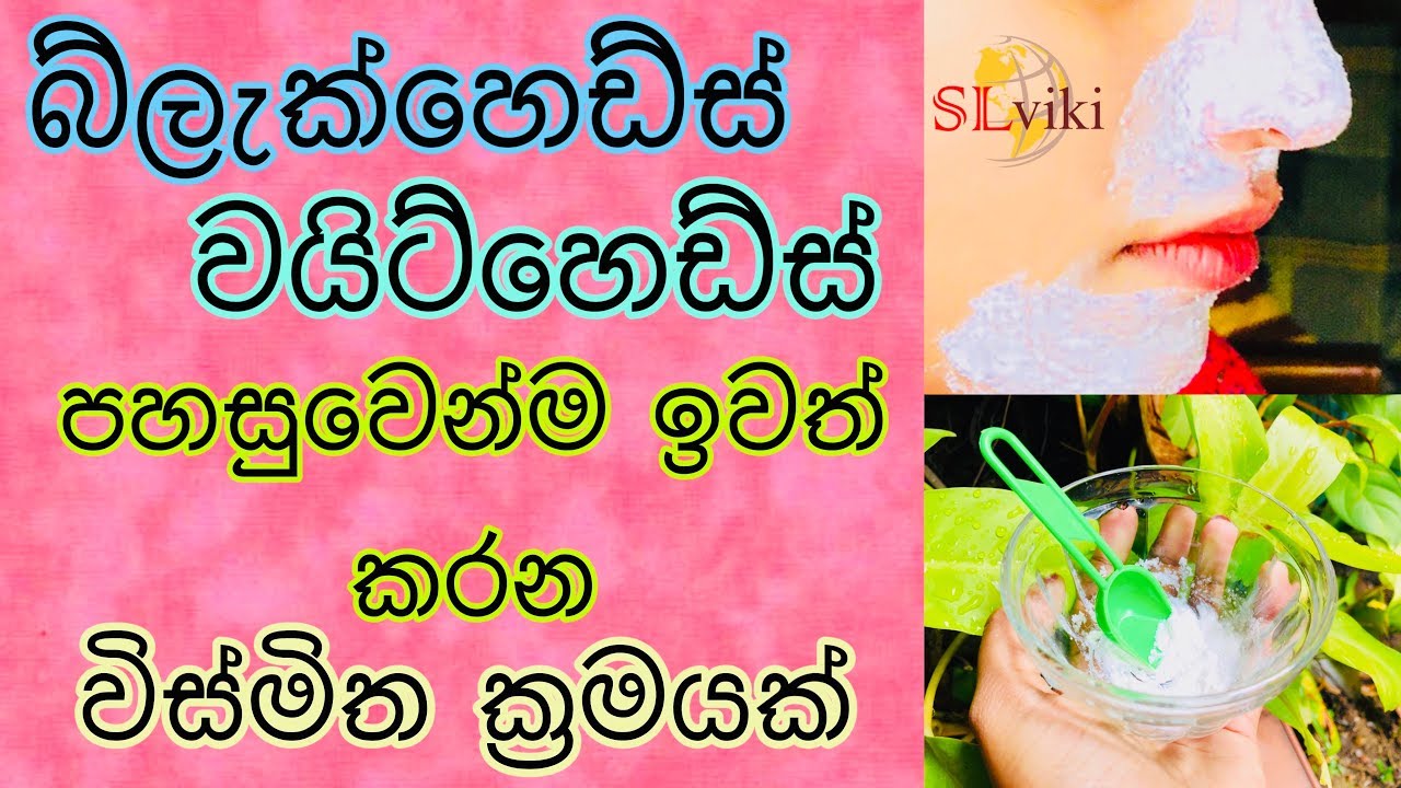 බ්ලැක්හෙඩ්ස් වයිට්හෙඩ්ස් පහසුවෙන්ම ඉවත් කරන ක්‍රමයක් | How to remove Blackheads & Whiteheads At Home