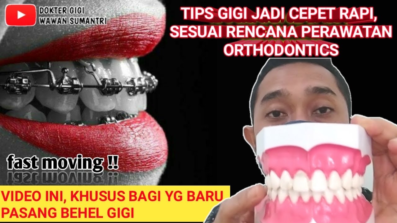 PERAWATAN SETELAH BEHEL GIGI TERPASANG PASIEN HARUS GIMANA? #pasangbehel #behelgigi #orthodontics