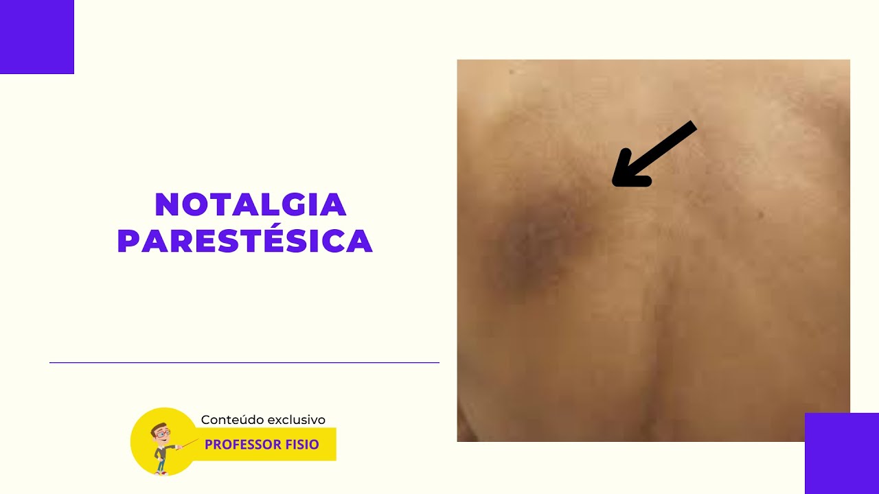 Notalgia Parestésica #doresnocorpo #dorescrônicas #psicosomática #doresnascostas