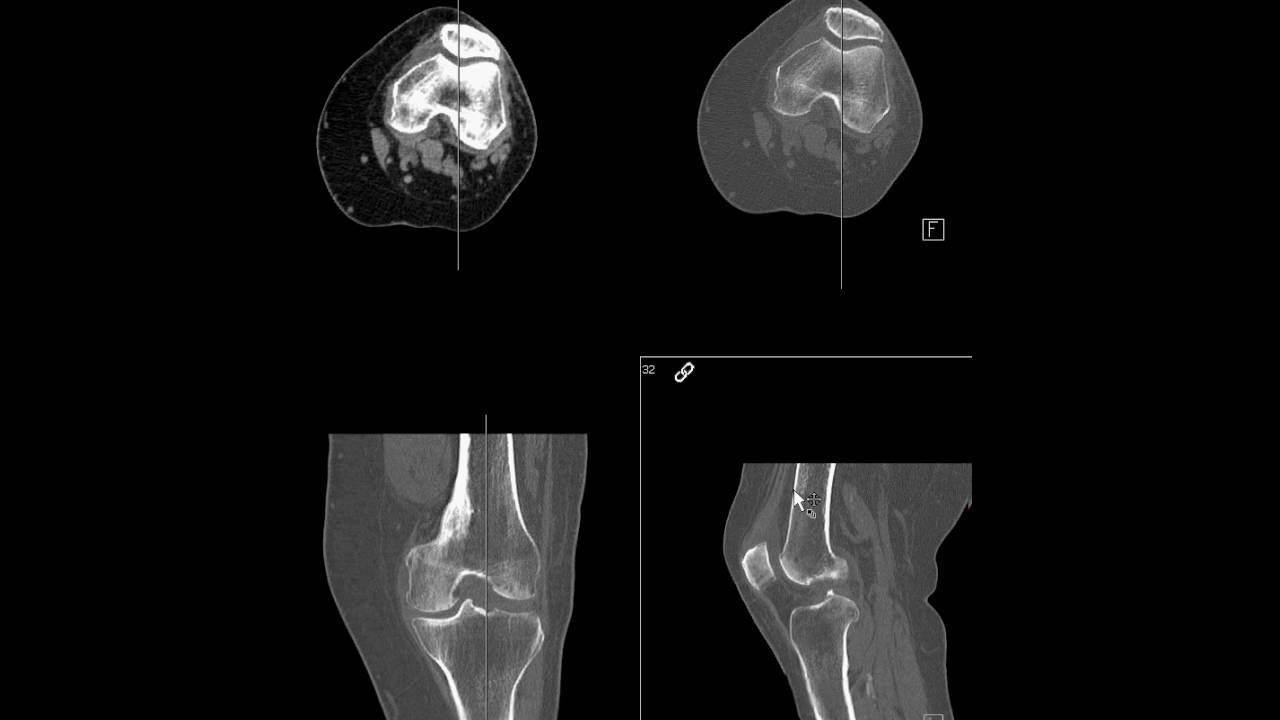 Knee CT imaging plane prescription