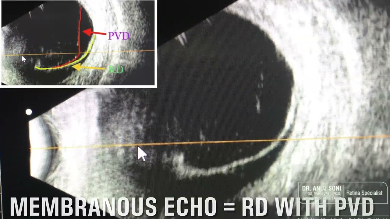 Retinal detachment and Retinal Tear on USG B scan