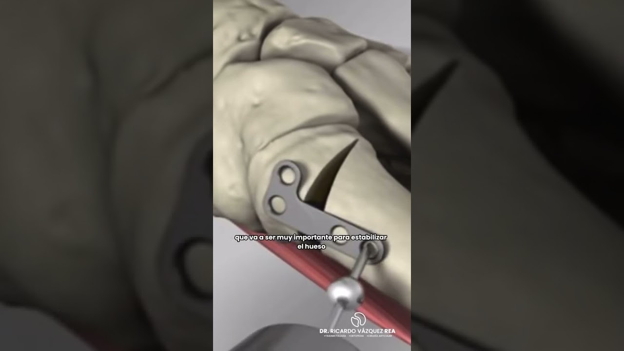 ¿Cómo se trata un hallux valgus (Juanete)? 🦶