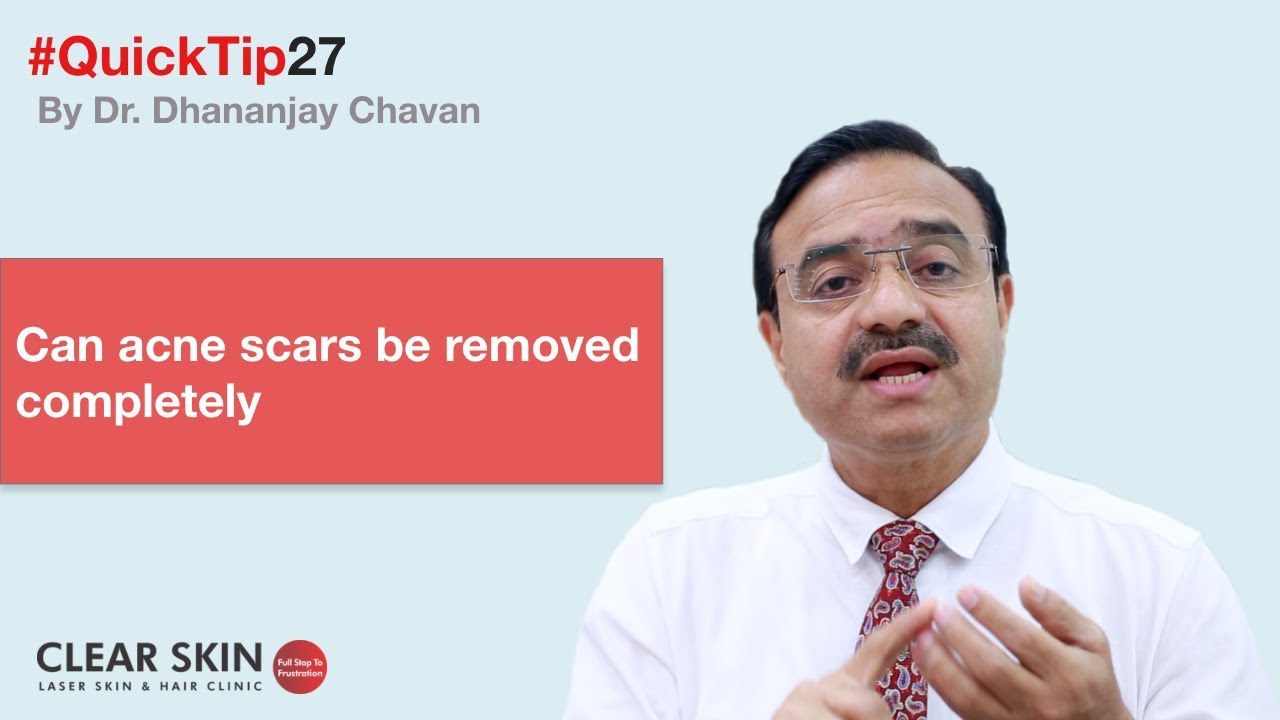 Can acne scars be removed completely | #ClearSkinTips 27 | ClearSkin, Pune | (In HINDI)