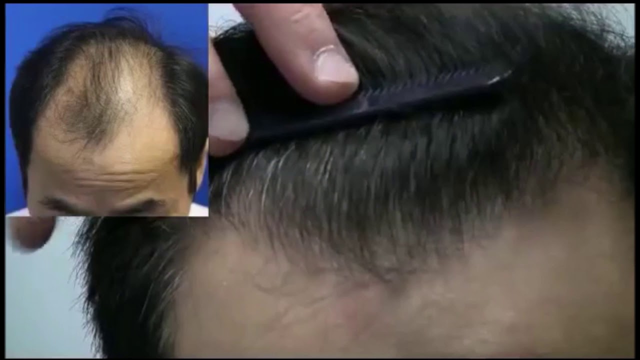 5000 FUE:  Nuhair Medical - Hair Transplant In Vancouver, Edmonton, Calgary, Winnipeg, Regina