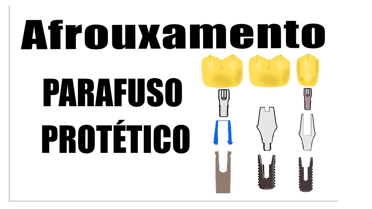 Compreenda o afrouxamento do parafuso protético em implante dentário [Conteúdo PsQi]