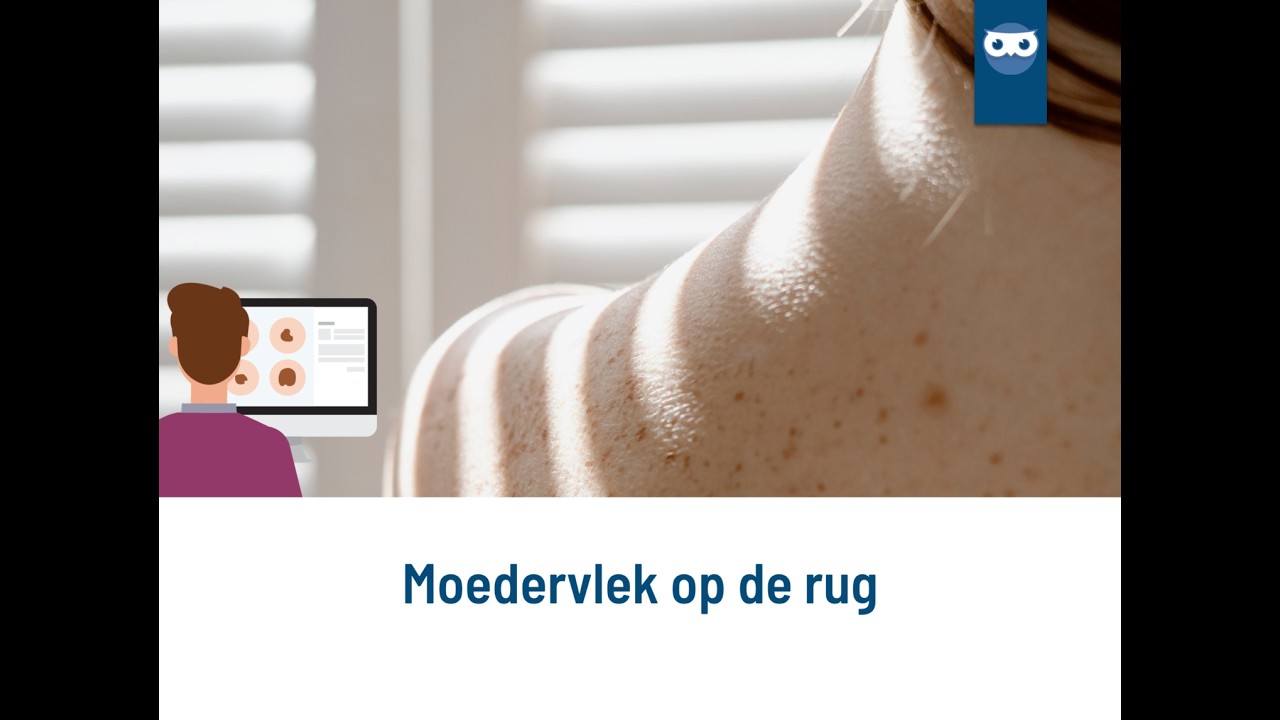 een lang bestaande moedervlek op de rug