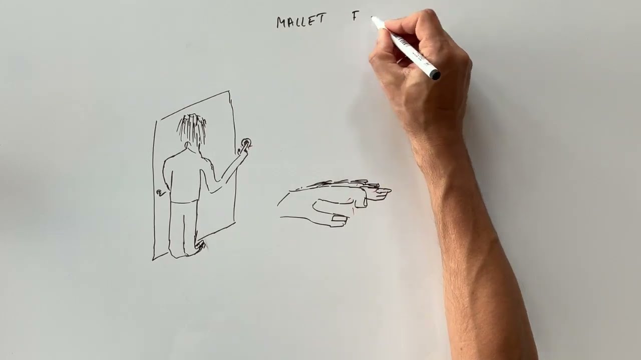 mallet finger, doigt en maillet, doigt qui tombe, doigt qui ne se relève plus
