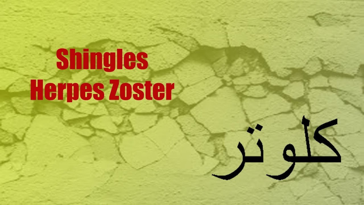 Shingles (Herpes Zoster / Kalwatar / کلوتر) Diagnosis - overview - Home Remedies
