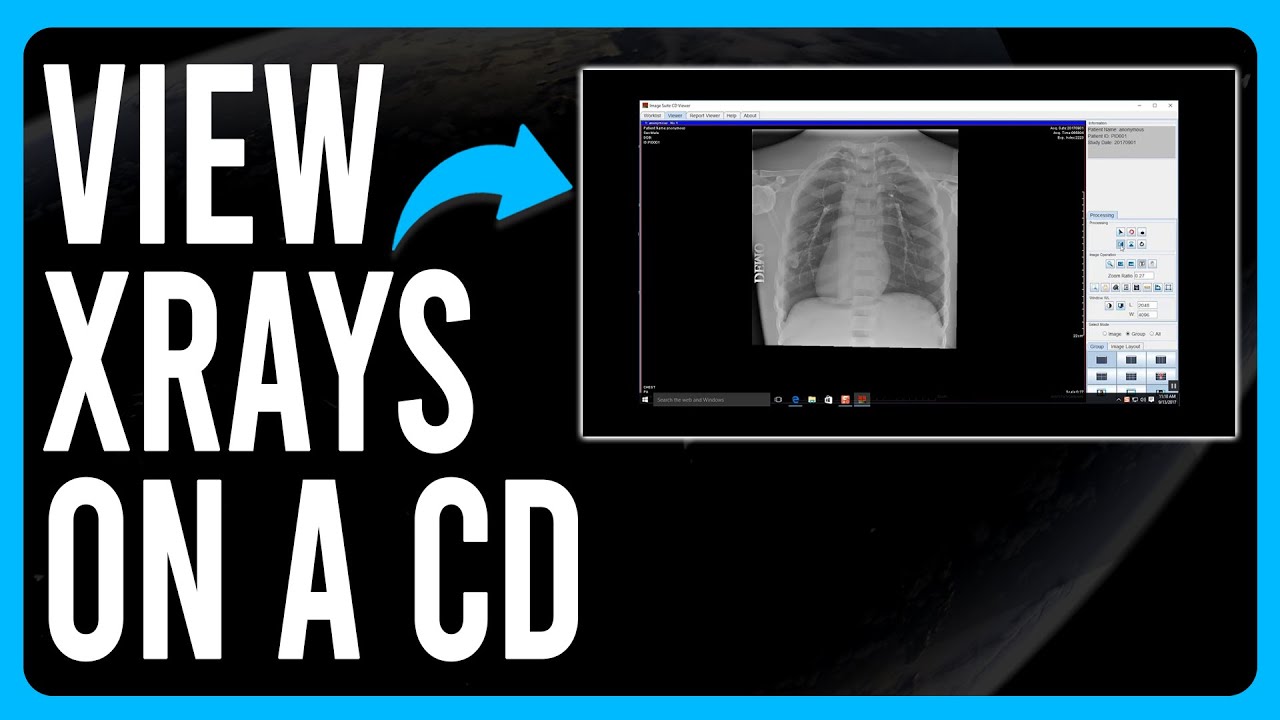 How to View X-Rays on a CD (How to Open X-Ray Images on Windows)