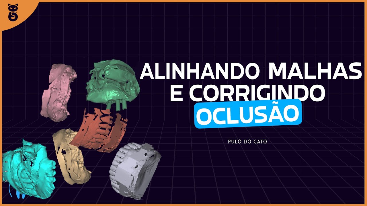 EXOCAD: Alinhar arquivos 3D e correção da oclusão com aumento de DVO no articulador virtual.