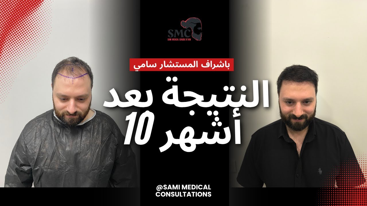 نتيجة زراعة الشعر بعد 10 اشهر مركز SMC اسطنبول