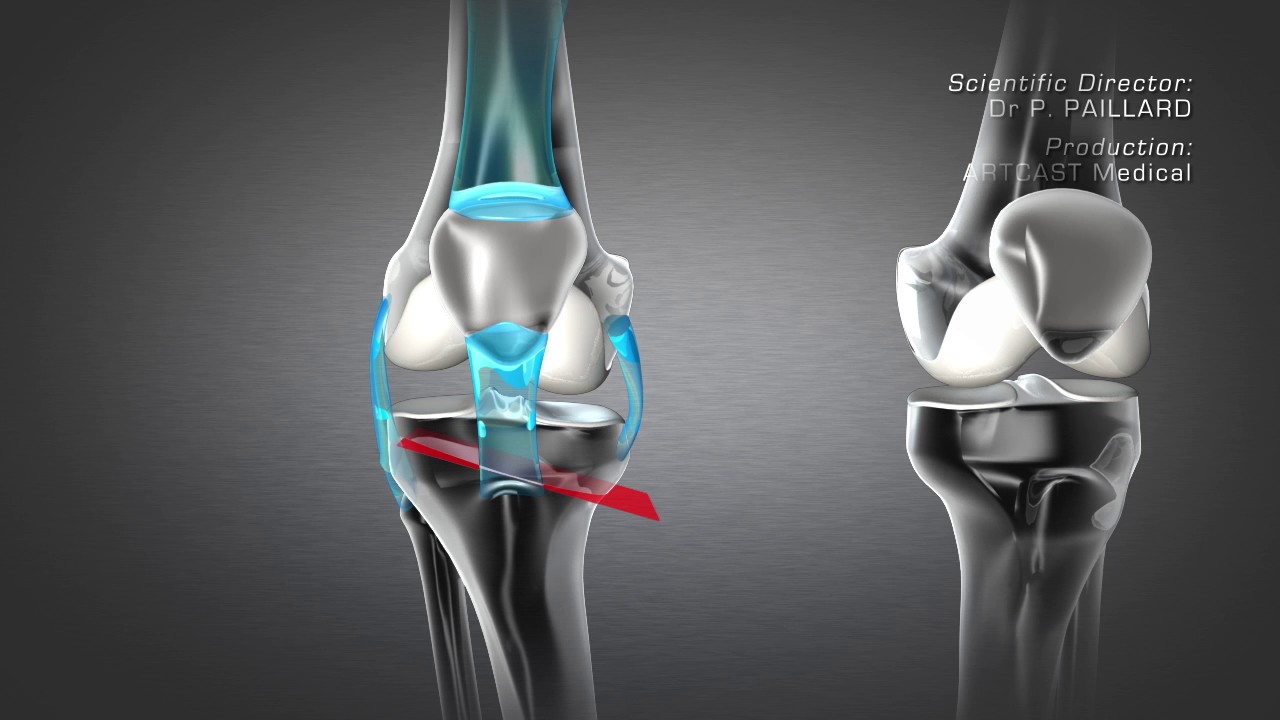 Tibial Valgus Osteotomy