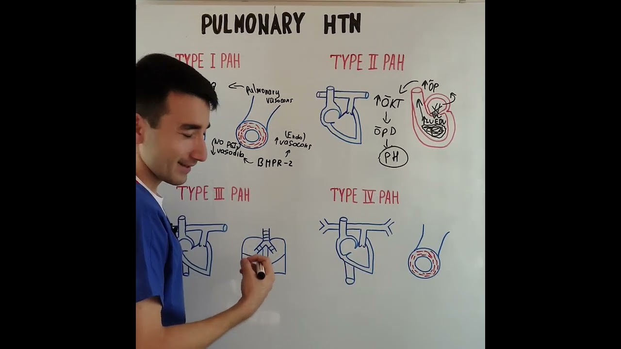 PULMONARY HYPERTENSION / O'PKA GIPERTENZIYASI.
