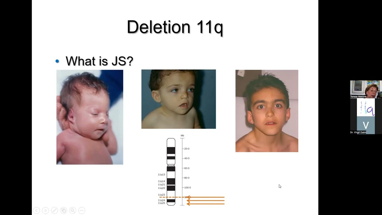 Natural History of Jacobsen Syndrome- Dr. Teresa Mattina