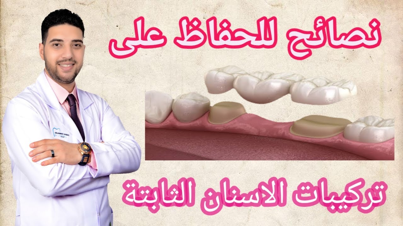 تعليمات بعد تركيب الاسنان الثابتة | 4 دقايق فيهم الخلاصة