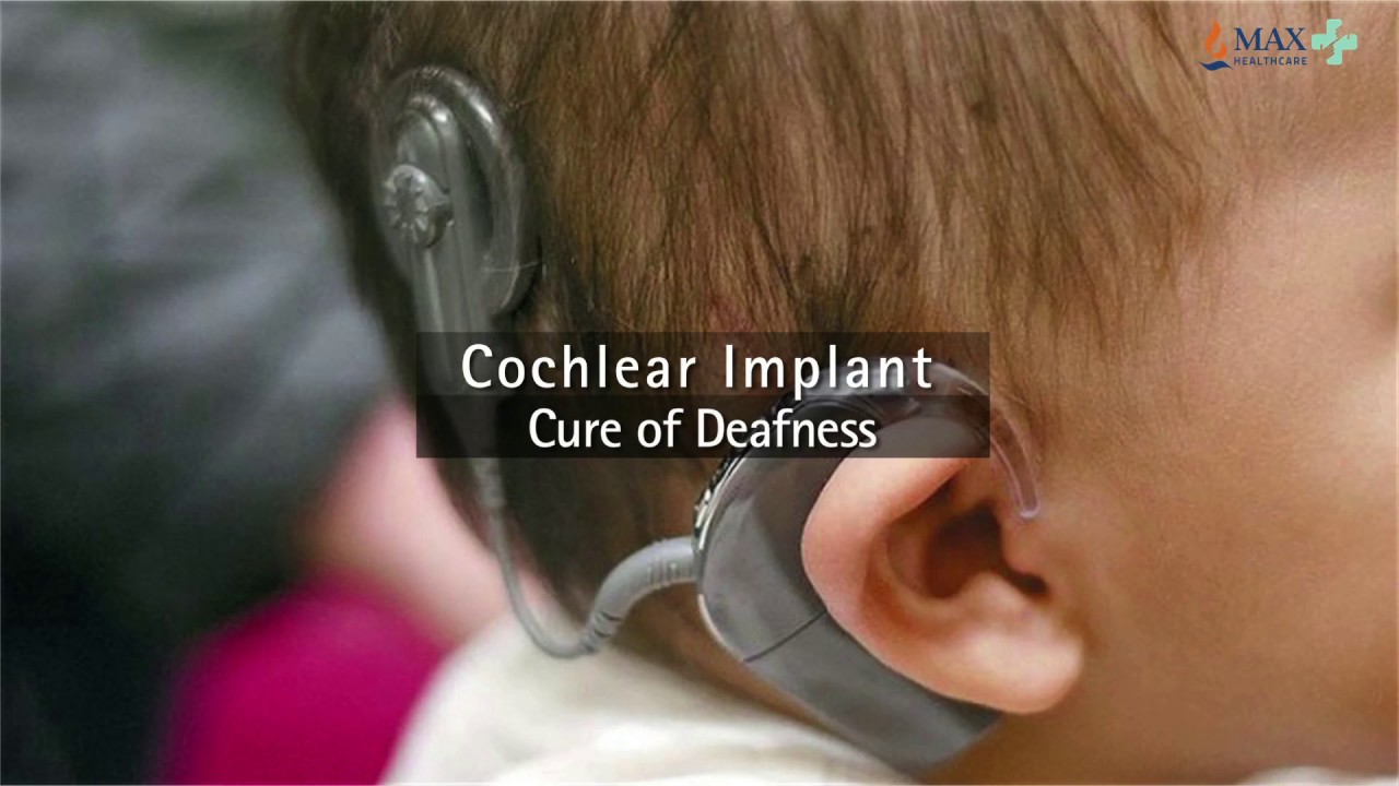 Curing deafness is possible: Cochlear Implants l Max Hospital, Pitampura