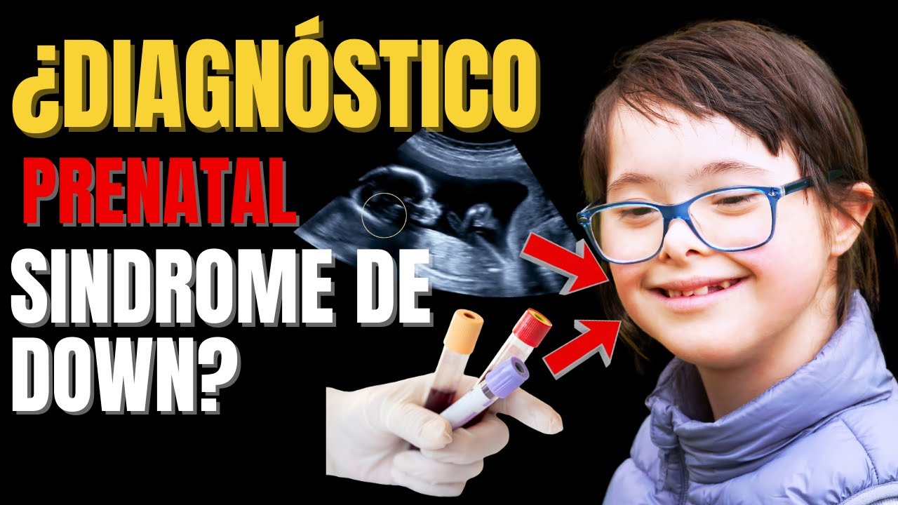 🔴DIAGNÓSTICO PRENATAL DEL SINDROME DE DOWN 🧬- Diagnosis of Down Syndrome
