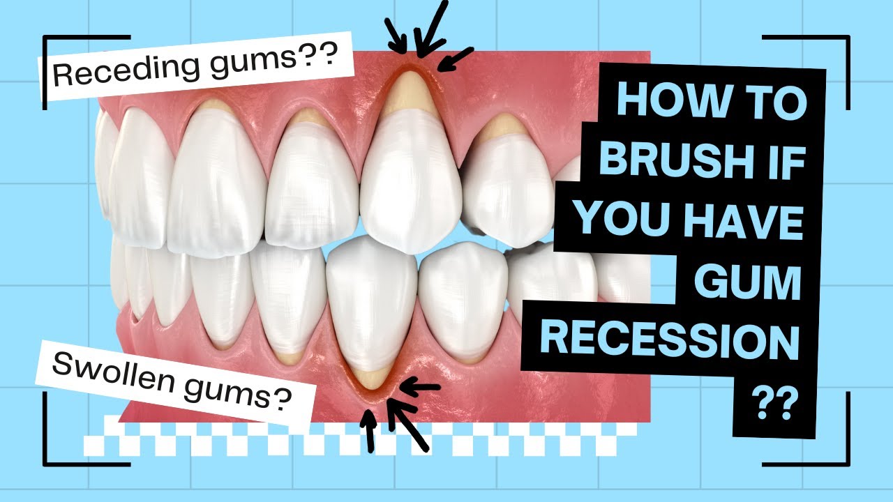 How To Brush Your Teeth If You Have Gum Recession? A Dental Hygienist’s Guide to Healthy Smiles! 😁