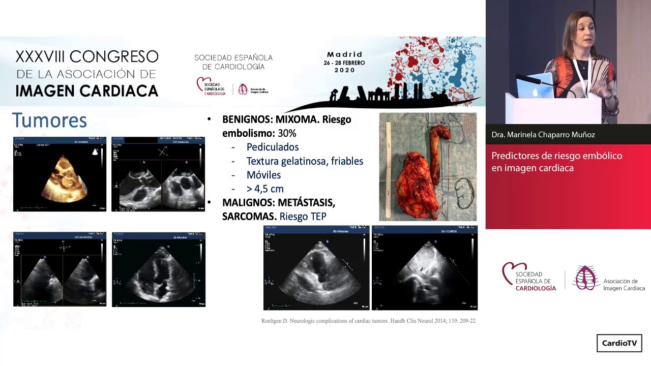 Preguntamos a los expertos sobre el papel de la imagen en pacientes con fibrilaci&oacute;n auricular