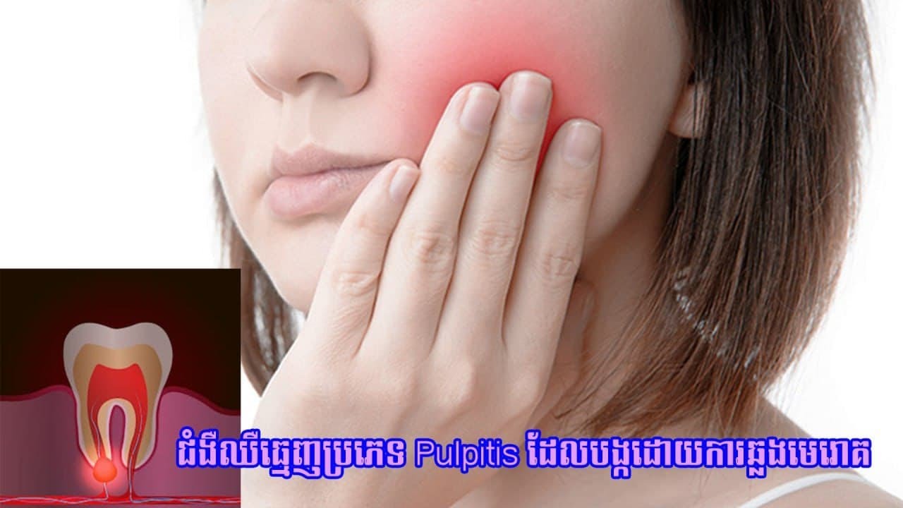 ការឈឺធ្មេញបណ្តាលមកពីការឆ្លងមេរោគ...