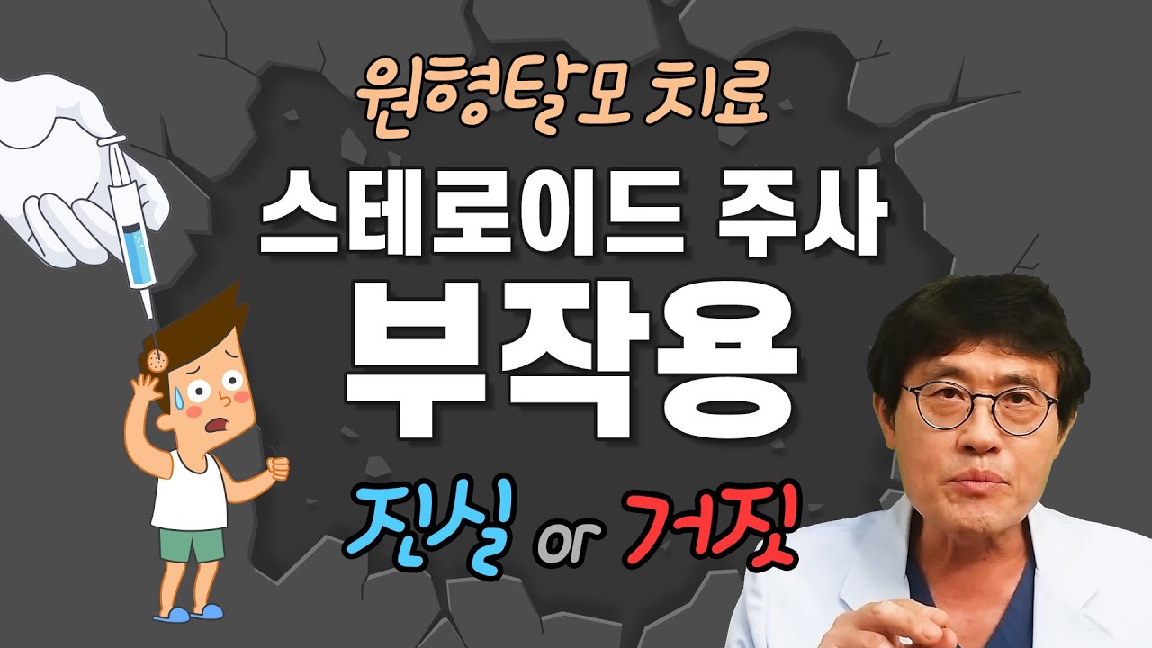 원형탈모 치료와 스테로이드주사 부작용, 진실 or 거짓 #원형탈모 #스테로이드주사 #탈모치료